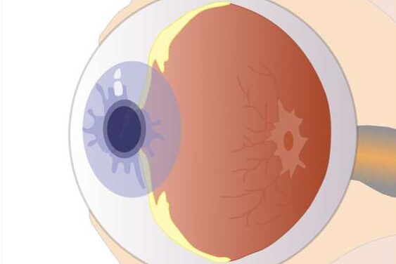 Researchers Find That Chromatically Simulated Myopic Blur May Be Useful As A Myopia Control Therapy