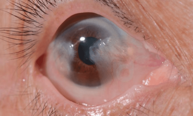 Cataract Awareness Month Drives Artificial Lenses Market