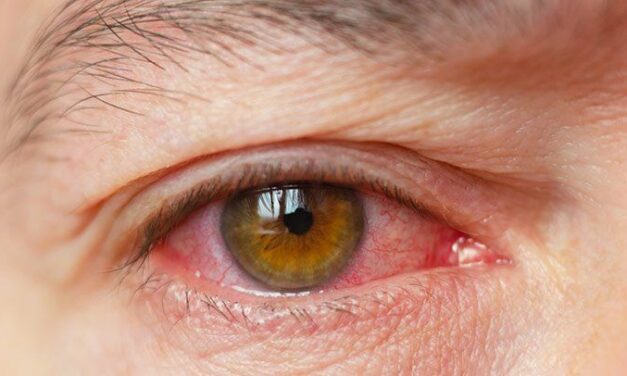 Effect of different artificial tears on tear film parameters in dry eye disease